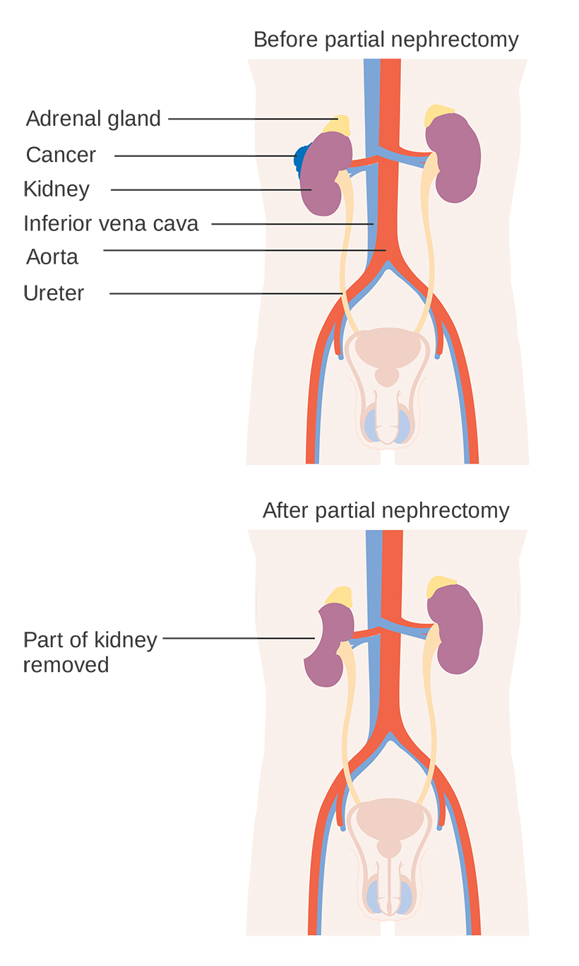 nephrectomy