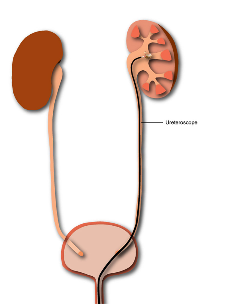 ureteroscopy diagram