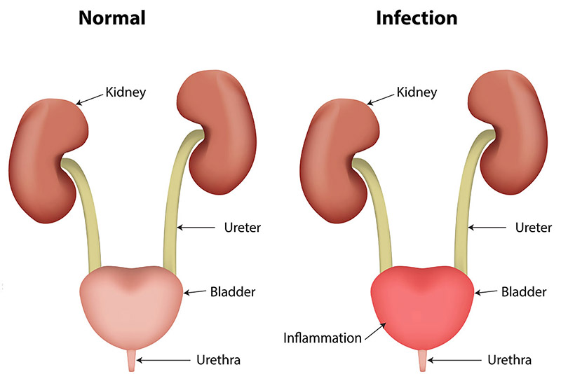 urinary-tract-infection-symptoms-and-treatments-of-urinary-tract