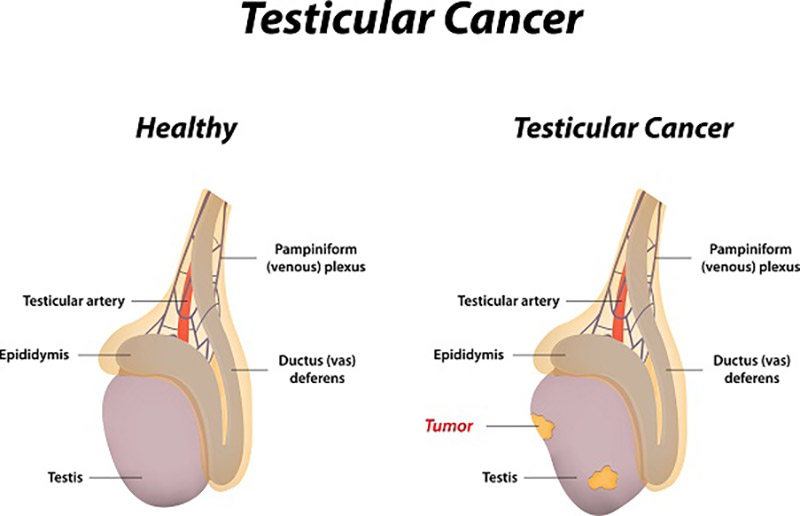 An Overview Of Testicular Cancer Urology Specialist