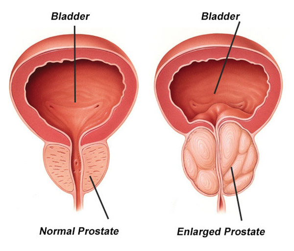 loss of median sulcus prostate