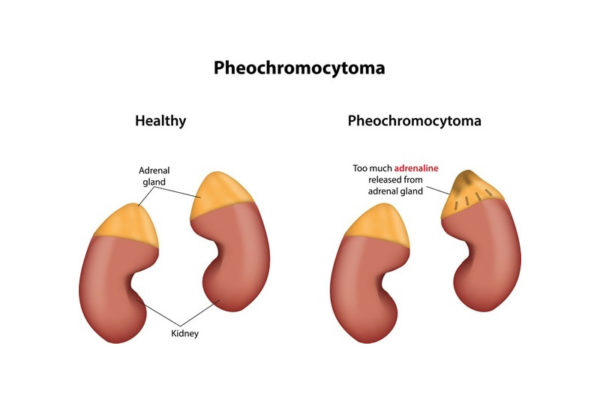 What Is A Pheochromocytoma Urology Specialist 1902