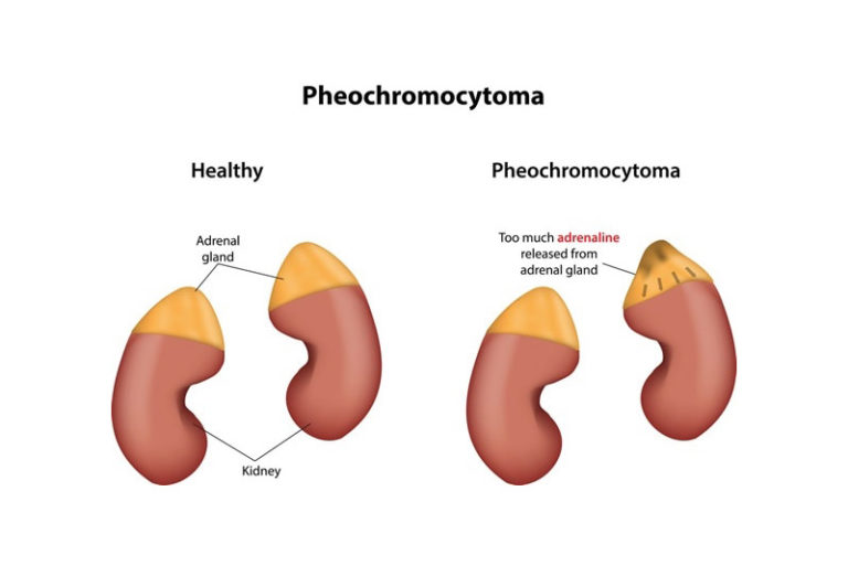 Pheochromocytoma And What You Need To Know Urology Specialist 2980