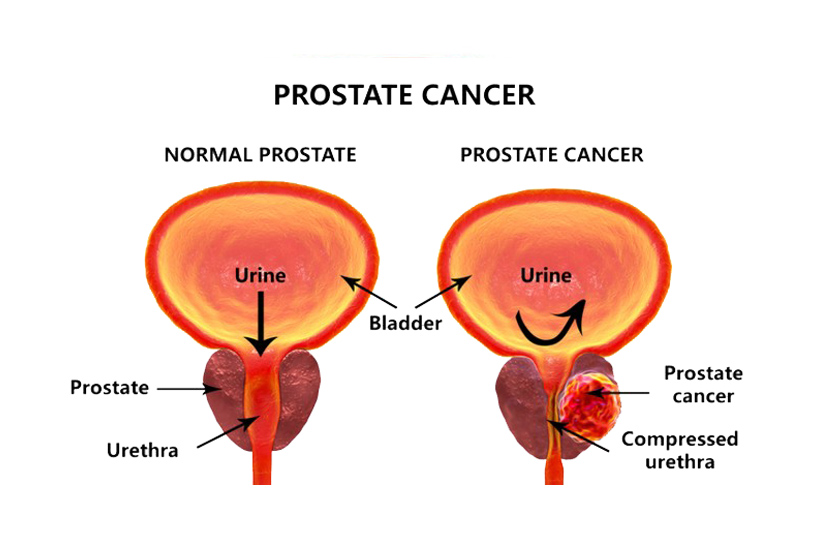 prostatitis vs prostate cancer symptoms)
