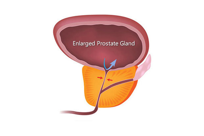 Prostate conditions