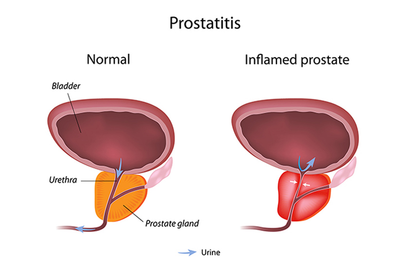 Prostatis