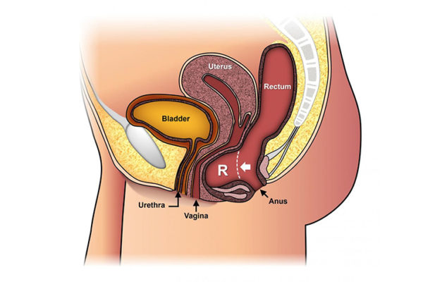 an-overview-of-holmium-laser-enucleation-of-the-prostate-holep