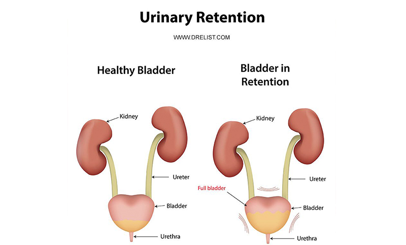 Retention Of Urine Meaning In Hindi