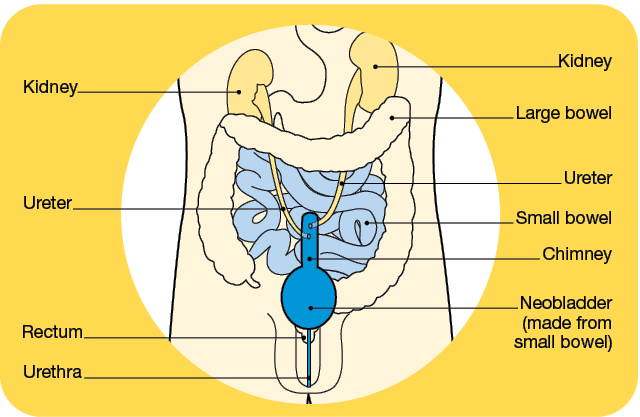 neobladder urinary bladder three types