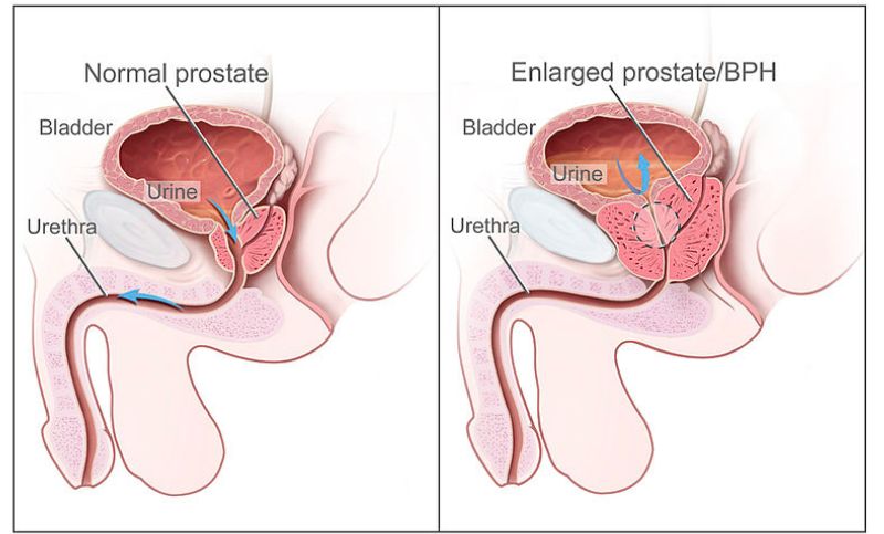 Demystifying Benign Prostatic Hypertrophy: Understanding Prostate Enlargement and Its Causes