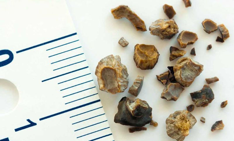 kidney stones sydney urology