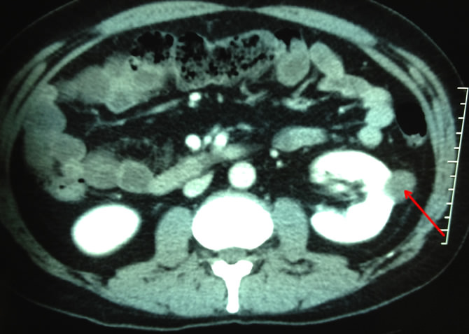 partial_nephrectomy