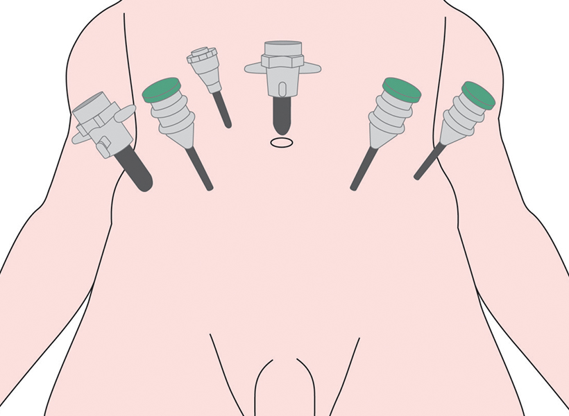 prostatectomy