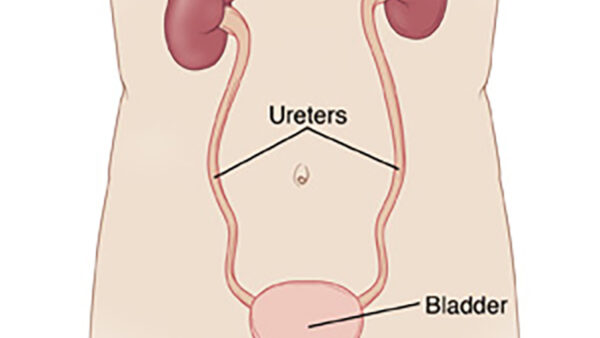 cystectomy