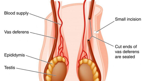 vasectomy diagram