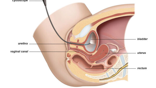Transurethral Resection of the Bladder