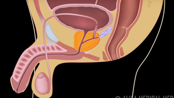 Holmium laser enucleation of the prostate