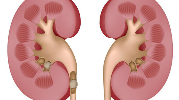 kidney stones