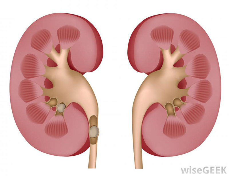 kidney stones