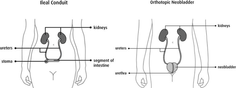 The 3 Different Types Of Urinary Diversion Explained Urology Specialist