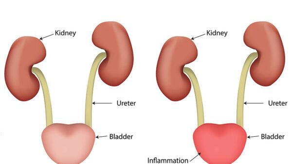urinary tract infection