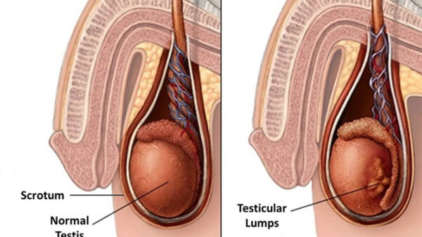 Testicular Cancer