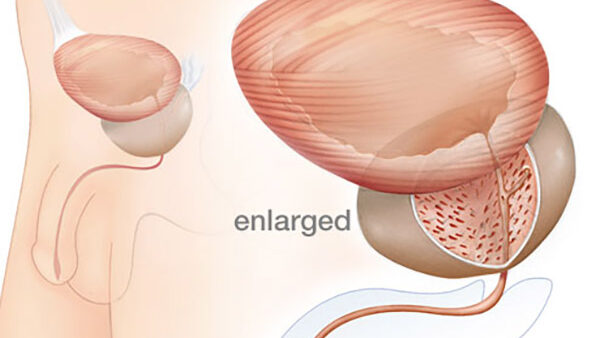 An Overview of Benign Prostatic Hyperplasia (BPH) or Enlarged Prostate