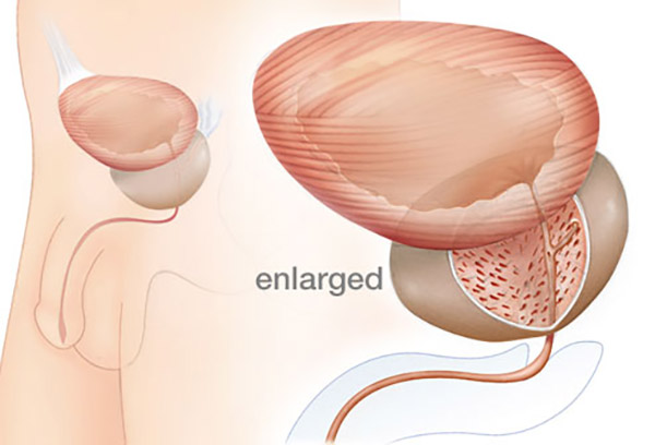 Benign Prostatic Hyperplasia