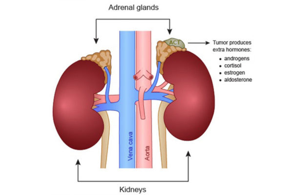 What is a Pheochromocytoma? | Urology Specialist