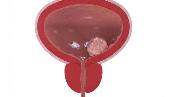 Bladder Cancer