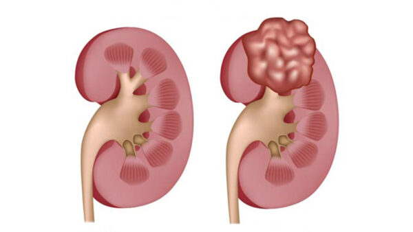 Kidney Cancer