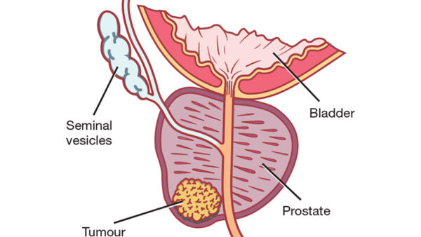 smoking prostate cancer