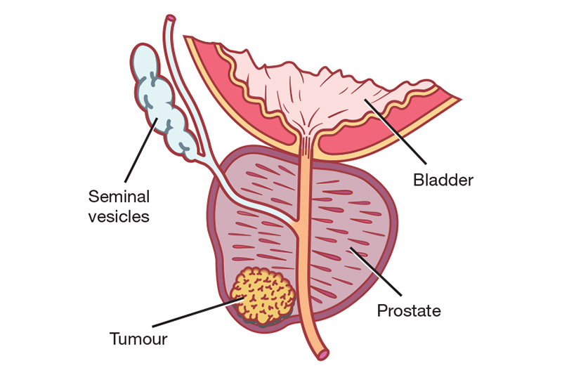 smoking prostate cancer