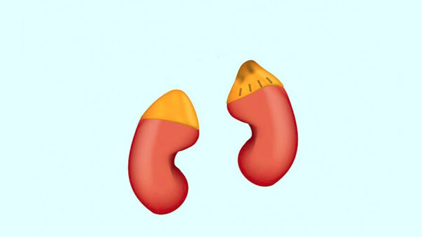 pheochromocytoma