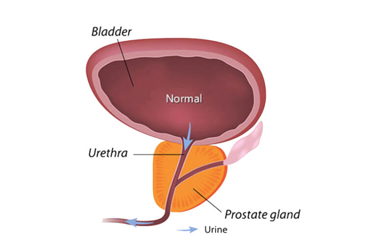 3 of the Most Common Prostate Conditions and their causes