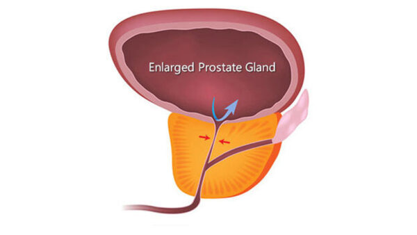 Prostate conditions