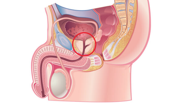 prostate surgery