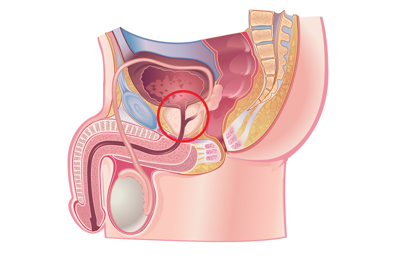 prostate surgery