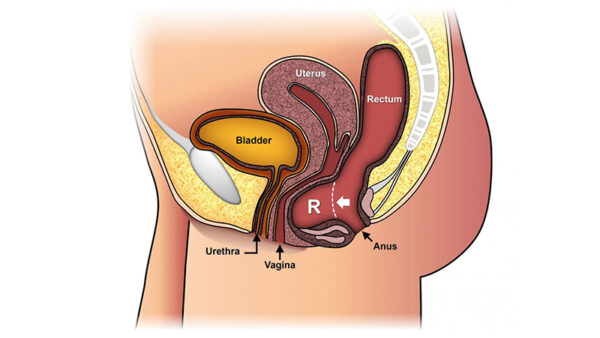 prolapsed bladder