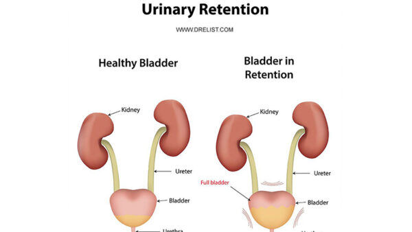 Urinary Retention