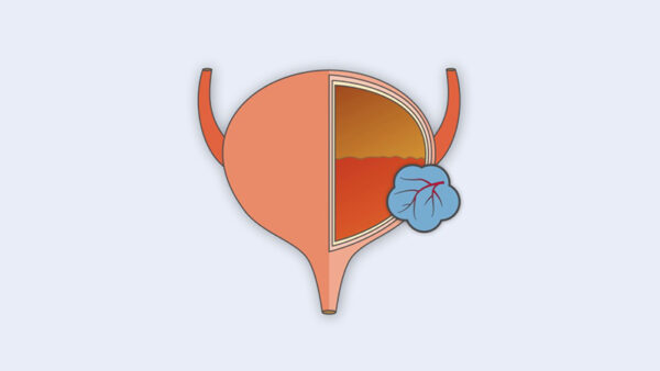 bladder cancer