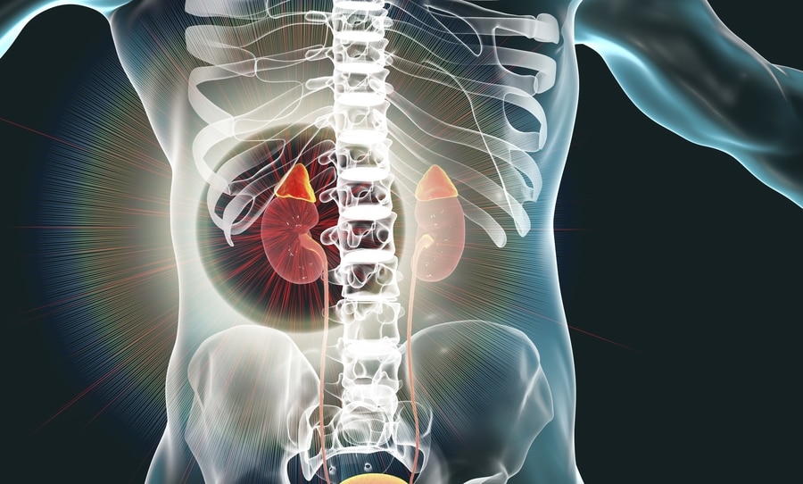 Pheochromocytoma