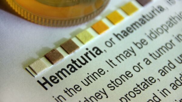 Hematuria