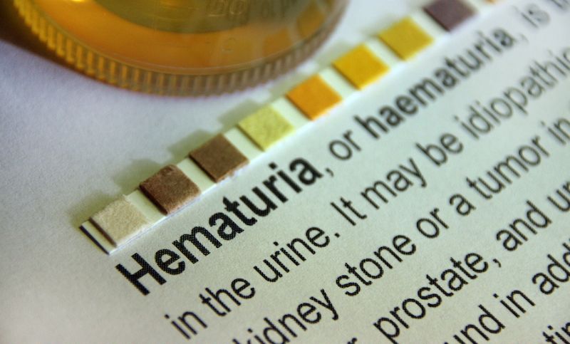 What Are The Most Common Causes Of Blood In The Urine (Hematuria)?