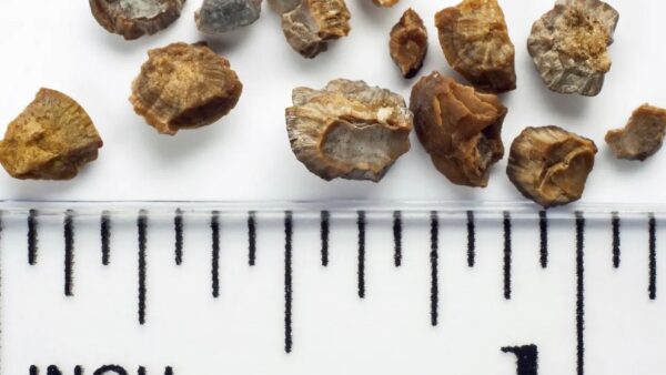 kidney stones treatment sydney