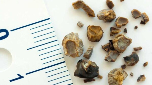 kidney stones sydney urology